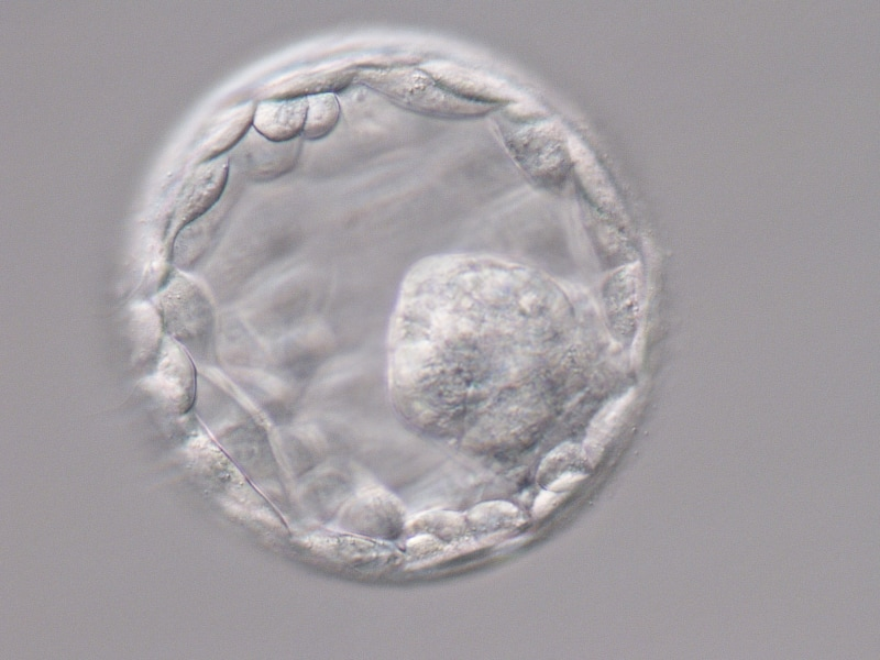 C&aacute;ch t&iacute;nh tuổi thai IVF chuyển ph&ocirc;i ng&agrave;y 5