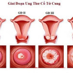 Có những loại xét nghiệm HPV cổ tử cung nào hiện có trên thị trường?
