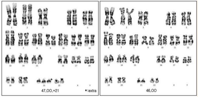 Nguy cơ z-score thường được sử dụng trong lĩnh vực nào?
