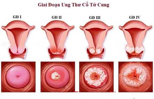 Xét nghiệm HPV bao lâu 1 lần: Điều bạn cần biết để bảo vệ sức khỏe