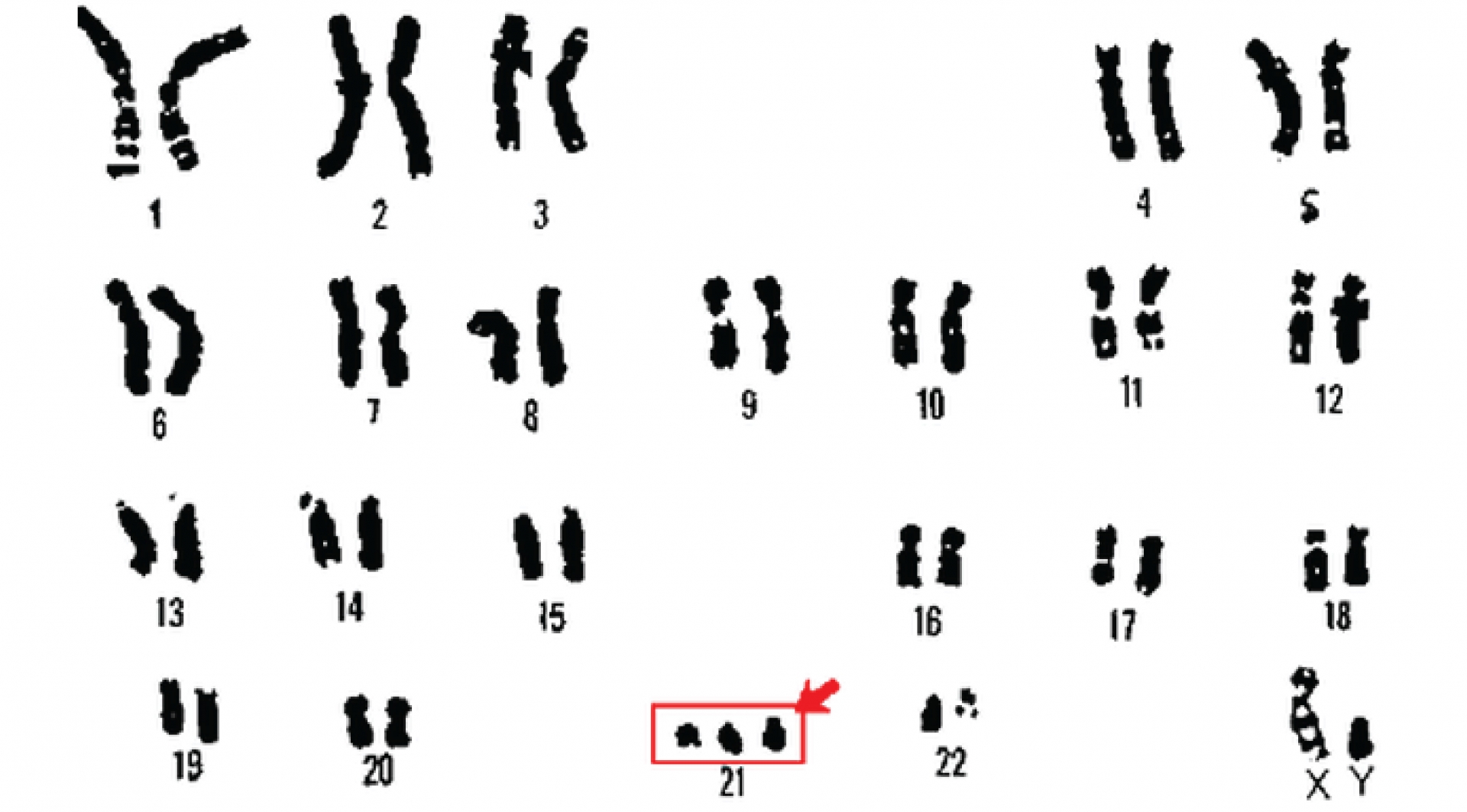 edward syndrome karyotype