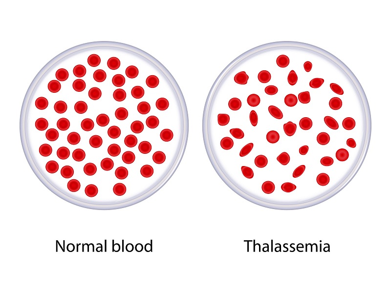 Tại sao Alpha Thalassemia do mất gen alpha?
