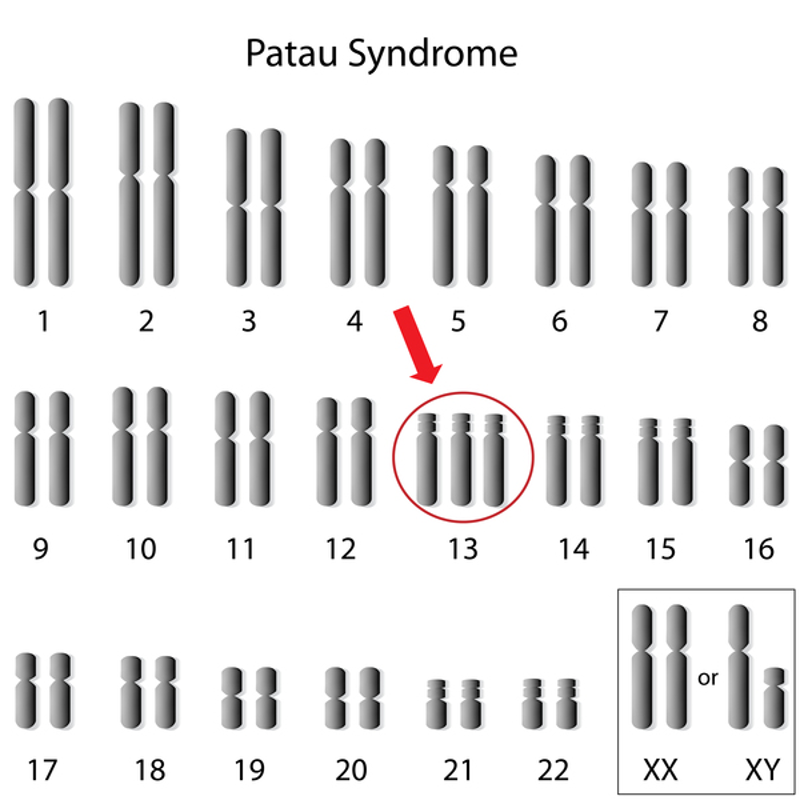 Xuất hiện thêm 1 NST số 13 ở trẻ mắc hội chứng Patau