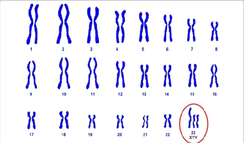 Ở nam giới mắc hội chứng si&ecirc;u nam, NST giới t&iacute;nh số 23 c&oacute; th&ecirc;m 1 NST Y