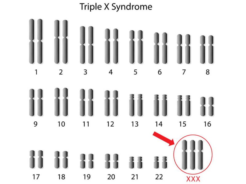 Trẻ mắc hội chứng si&ecirc;u nữ sẽ c&oacute; 3 nhiễm sắc thể X ở cặp NST giới t&iacute;nh thay v&igrave; 2