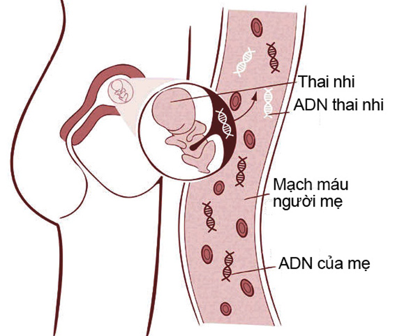 NIPT ph&acirc;n t&iacute;ch ADN tự do của thai nhi trong m&aacute;u mẹ để s&agrave;ng lọc hội chứng si&ecirc;u nữ