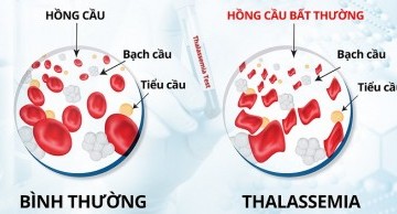 hoi_thao_thalassemia_03.07/thalassemia-01.jpg
