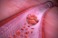 Tìm hiểu về Thrombophilia và sảy thai liên tiếp