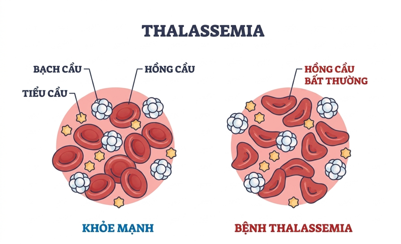 Sự kh&aacute;c biệt r&otilde; rệt giữa m&aacute;u người b&igrave;nh thường v&agrave; người mắc bệnh tan m&aacute;u bẩm sinh Thalassemia&nbsp;