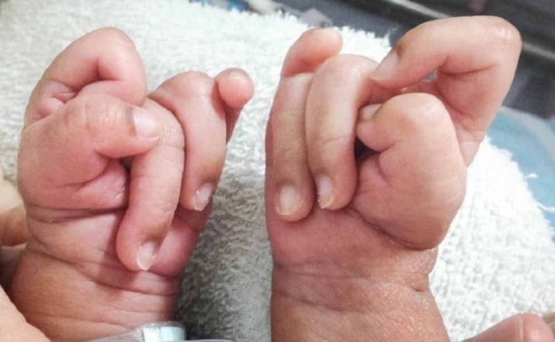 B&agrave;n tay nắm chặt với ng&oacute;n tay chồng l&ecirc;n nhau ở trẻ mắc hội chứng Edwards