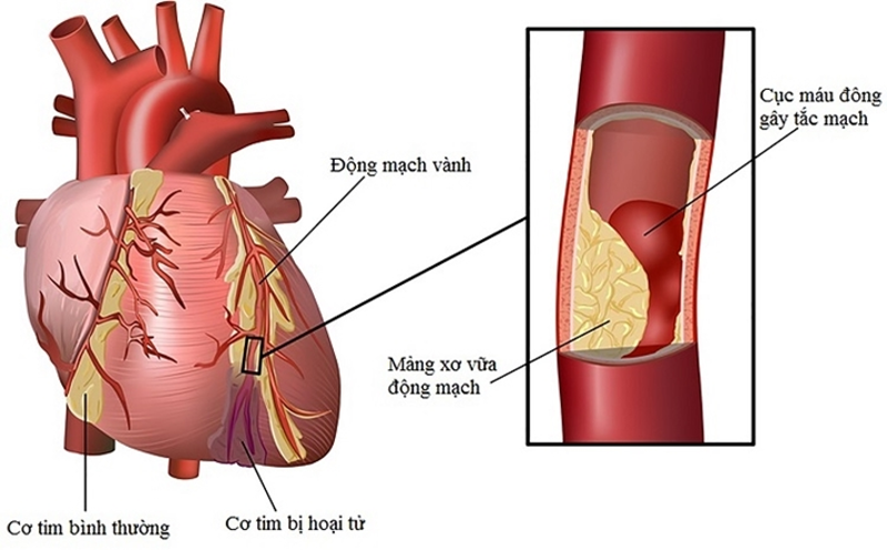 Mảng xơ vữa động mạch g&acirc;y tắc nghẹn động mạch