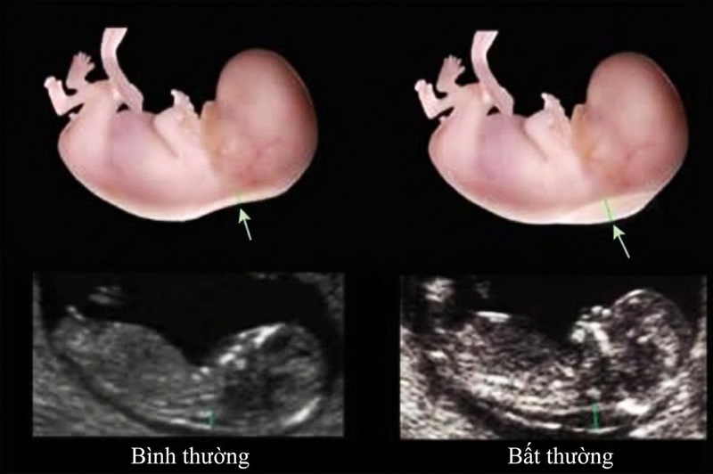 Si&ecirc;u &acirc;m đo độ mờ da g&aacute;y ở thai nhi b&igrave;nh thường v&agrave; thai nhi mắc hội chứng dị tật bẩm sinh