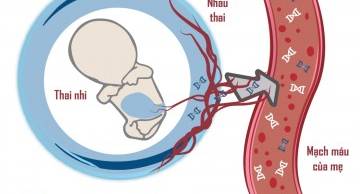 Phân số thai nhi (FF) thấp dẫn đến kết quả xét nghiệm NIPT không xác định