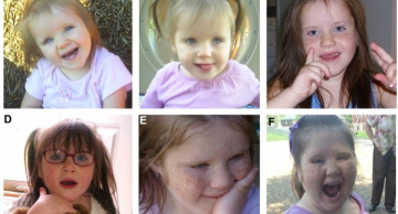 Hội chứng mất đoạn 1P36