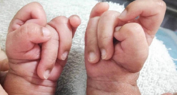 Hội chứng Edwards là gì