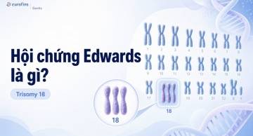 Hội chứng Edwards là gì