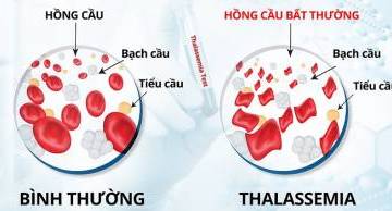Ý nghĩa xét nghiệm Điện di huyết sắc tố và xét nghiệm Gen trong chẩn đoán bệnh THALASSEMIA