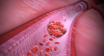 Tìm hiểu về Thrombophilia và sảy thai liên tiếp