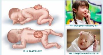 Mẹ bầu nên sàng lọc dị tật thai nhi ở đâu tốt nhất?