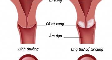 Xét nghiệm HPV có chính xác hay không?