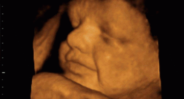 Dấu hiệu thai nhi bị dị tật mẹ bầu nhất định phải biết