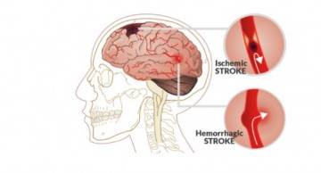 Đột quỵ liệu có thể biết trước để phòng tránh?