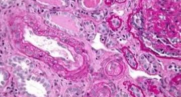 Hội chứng Antiphospholipid trong thai sản