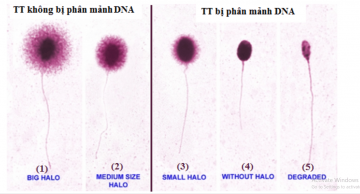Xét nghiệm phân mảnh ADN tinh trùng ở đâu uy tín