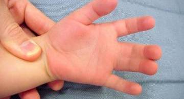 Top 7 những dị tật bẩm sinh hiếm gặp nhất mẹ bầu cần biết