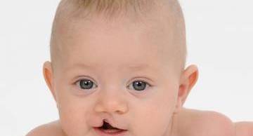 Dị tật bẩm sinh có di truyền không? Cách ngăn ngừa từ sớm