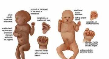 Hội chứng Patau là gì?