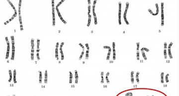 Hội chứng Jacobs là gì?