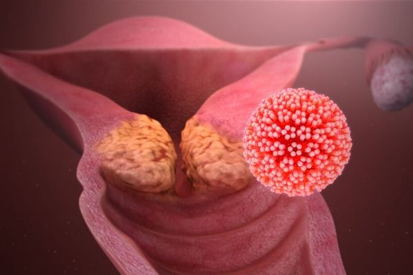 Chẩn đoán bệnh do virus HPV type 68 theo cách nào?
