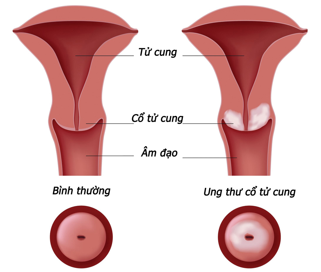 xét nghiệm HPV có chính xác không