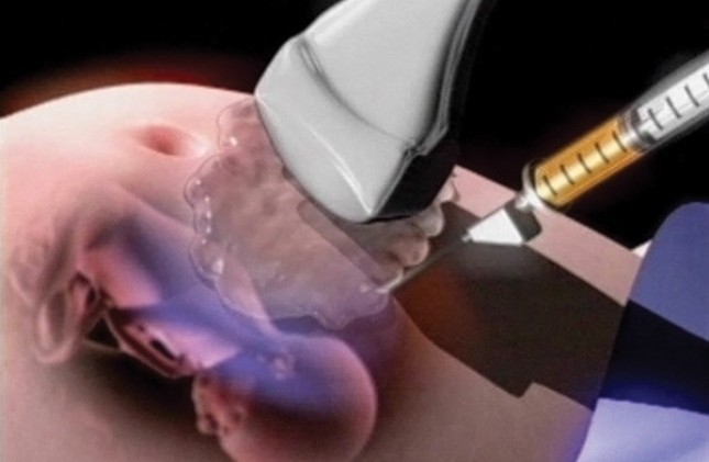 Hỏi - đáp: Kỹ thuật lấy nước ối có an toàn không?