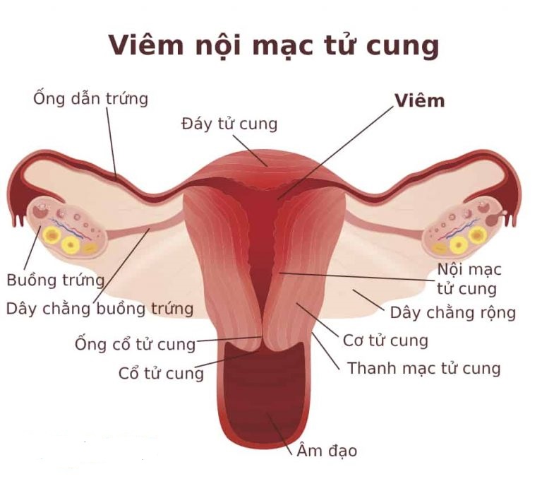 ThS. Trần Ngọc Minh chia sẻ về Viêm niêm mạc tử cung mạn tính tại ...