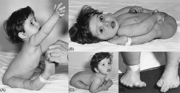 Biểu hiện lỏng các khớp xương ở trẻ mắc hội chứng Ehlers-Danlos