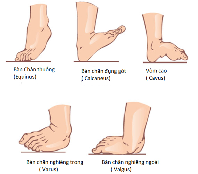 Dị tật bàn chân ở bé 