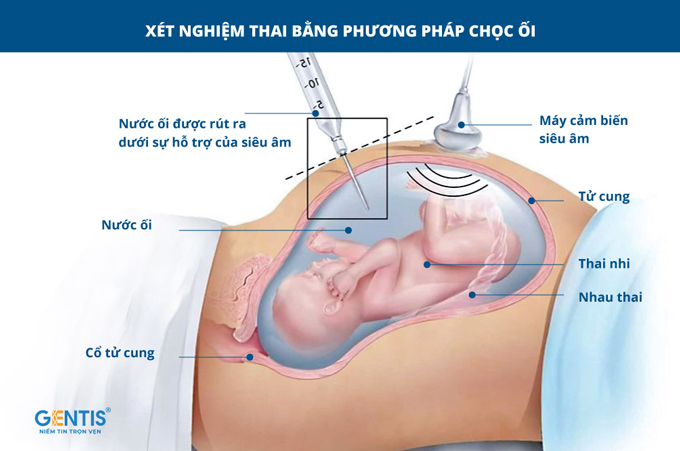 Sàng Lọc Bệnh Down: Phương Pháp Hiệu Quả Cho Sức Khỏe Thai Nhi