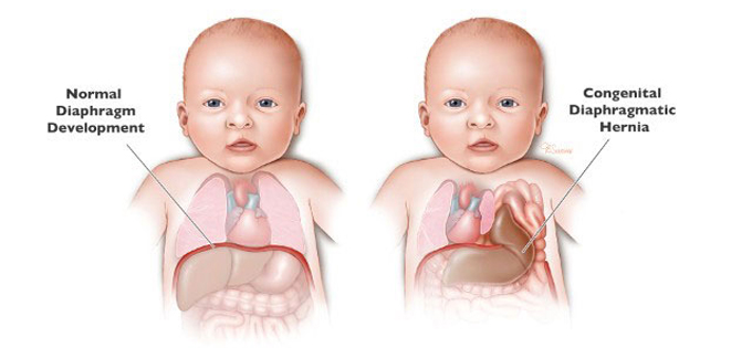 Thoát vị hoành bẩm sinh do còn ống phế - phúc mạc 