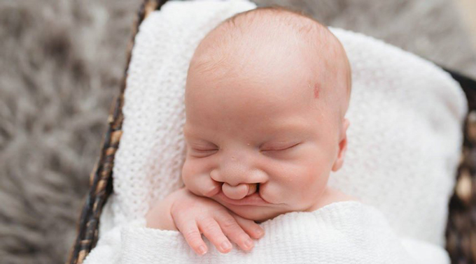 Biểu hiện của hội chứng Patau 