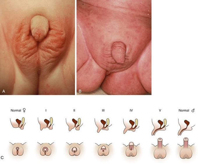 Trẻ gái sinh ra với biểu hiện nam hóa bộ phận sinh dục ngoài 