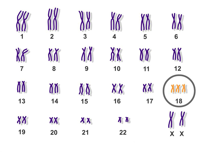 Hội chứng Edwards liên quan đến những bất thường ở nhiễm sắc thể số 18.