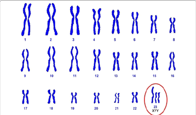 Hội chứng Jacobs xảy ra ở bé nam khi có 2 nhiễm sắc thể Y (XYY).