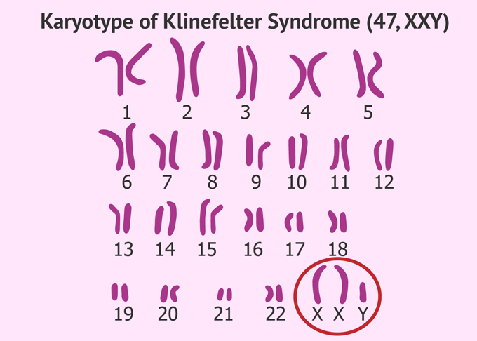 Nhiễm sắc thể của người mắc hội chứng klinefelter