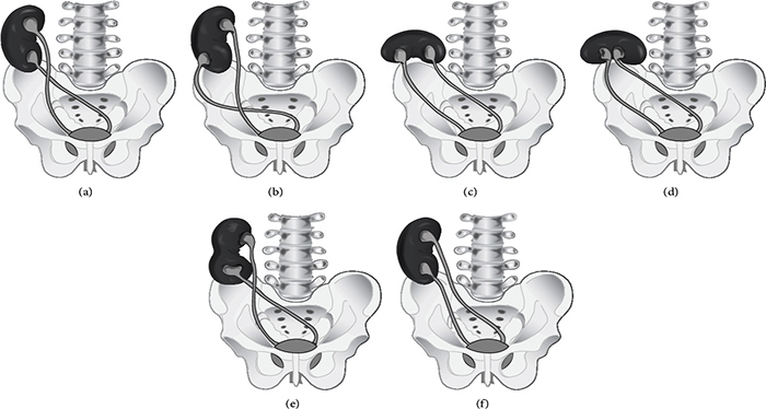 thận hợp nhất lạc chỗ