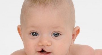 Dị tật bẩm sinh có di truyền không