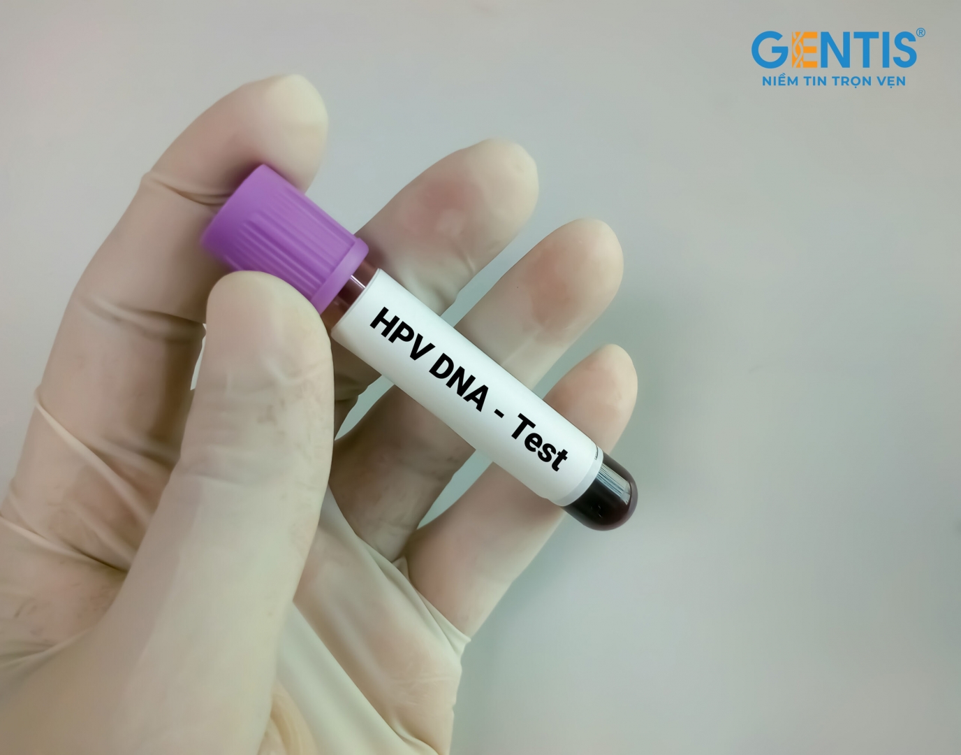 3. Quy Trình Thực Hiện Xét Nghiệm HPV DNA