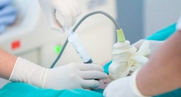 Chọc ối xét nghiệm ADN