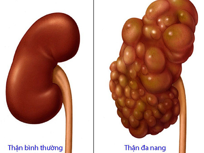 so sánh thận bình thường và thận đa nang